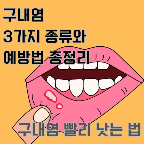 구내염 3가지 종류와 예방법에 대해서 알아봅니다.