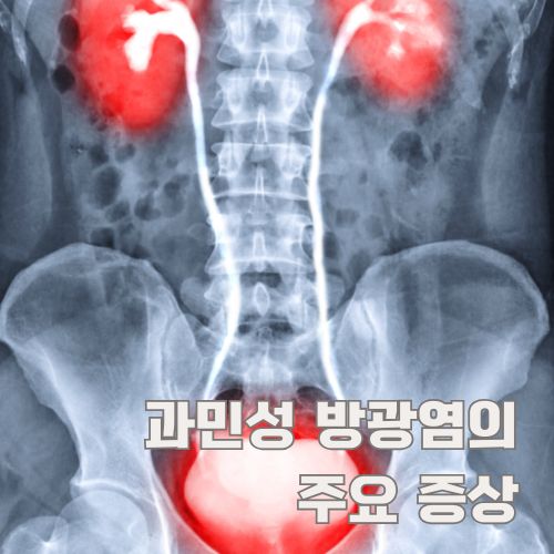 과민성 방광염의 주요 증상을 보여주는 엑스레이 이미지와 강조된 방광 부위